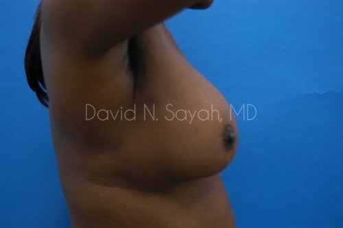 Breast Implant Revision Before and After | Sayah Institute