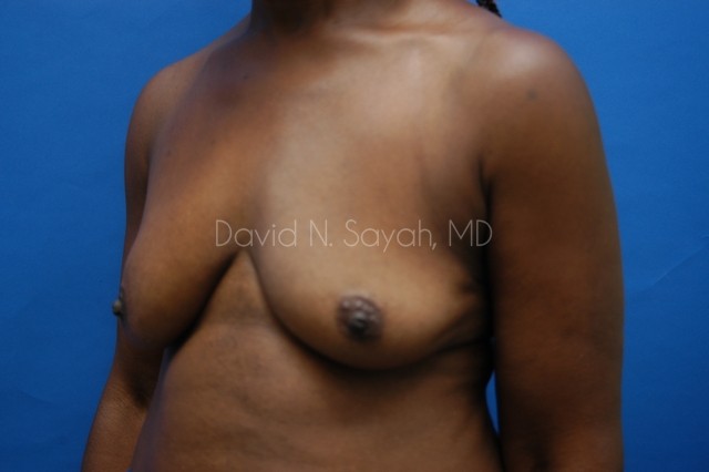 Breast Implant Revision Before and After | Sayah Institute