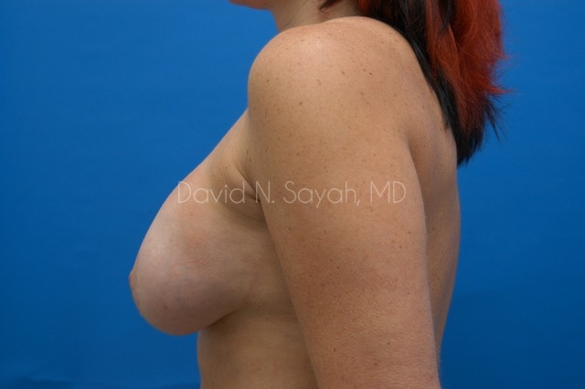 Breast Implant Revision Before and After | Sayah Institute