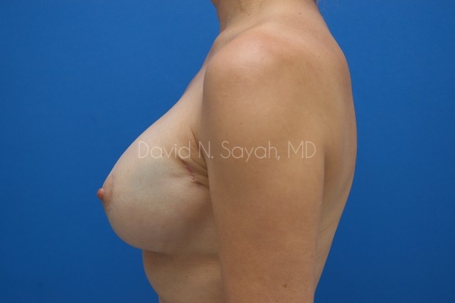Breast Implant Revision Before and After | Sayah Institute