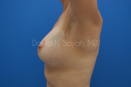 Breast Implant Revision Before and After | Sayah Institute