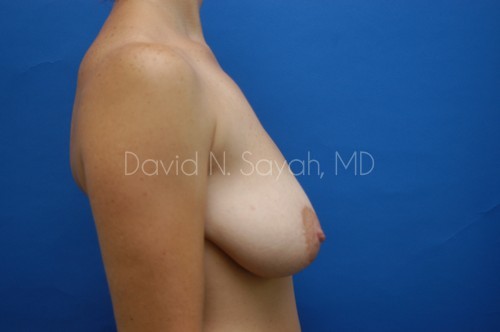 Breast Lift Before and After | Sayah Institute