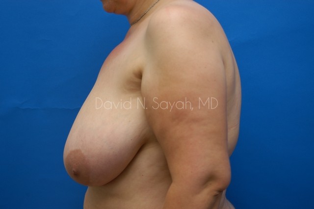 Breast Lift Before and After | Sayah Institute