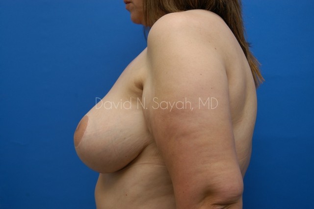 Breast Lift Before and After | Sayah Institute