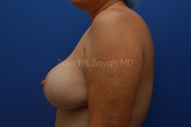 Breast Lift Before and After | Sayah Institute