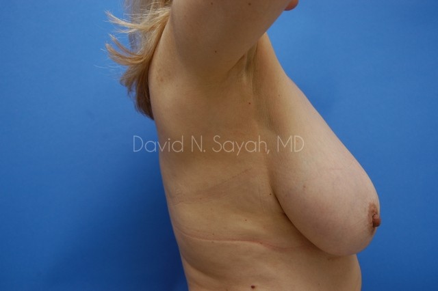 Breast Lift Before and After | Sayah Institute