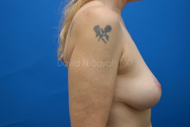 Breast Lift Before and After | Sayah Institute