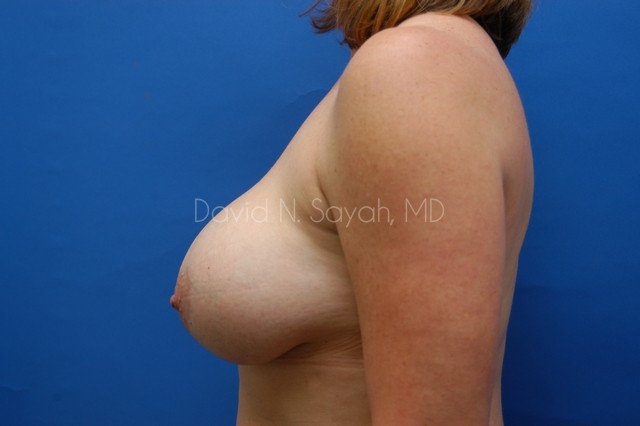 Breast Lift Before and After | Sayah Institute
