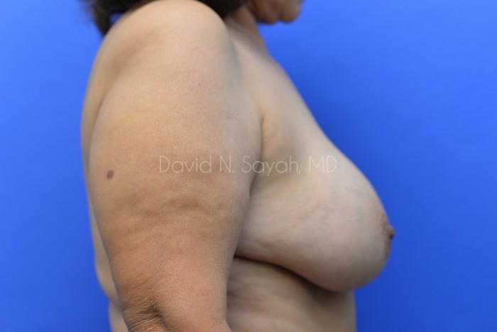 Breast Reconstruction Before and After | Sayah Institute