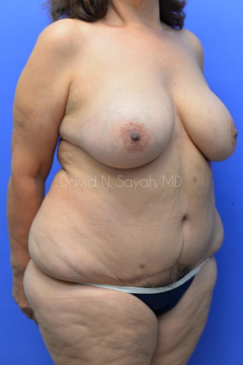 Breast Reconstruction Before and After | Sayah Institute