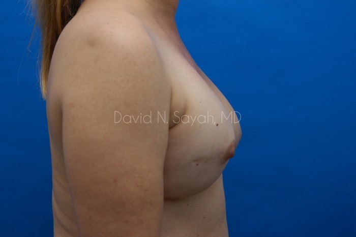Breast Reconstruction Before and After | Sayah Institute