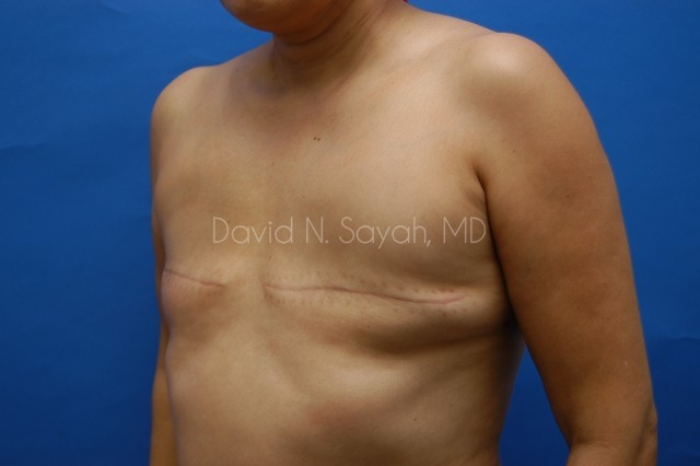 Breast Reconstruction Before and After | Sayah Institute