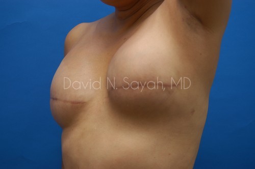 Breast Reconstruction Before and After | Sayah Institute