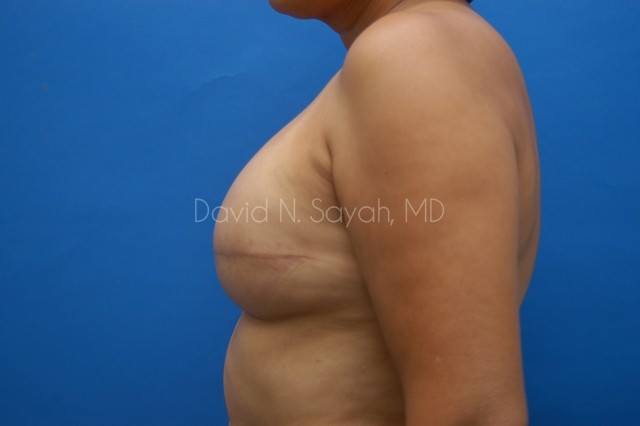Breast Reconstruction Before and After | Sayah Institute