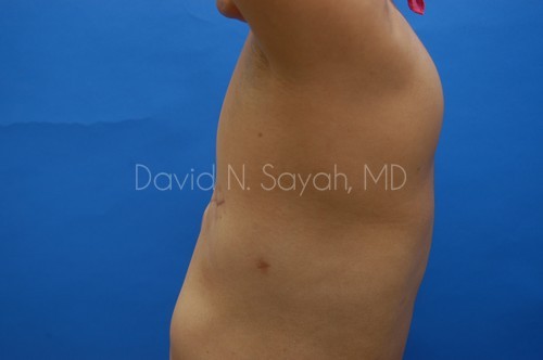 Breast Reconstruction Before and After | Sayah Institute