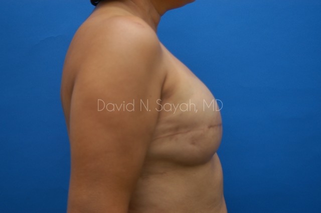 Breast Reconstruction Before and After | Sayah Institute