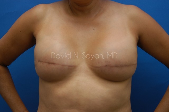 Breast Reconstruction Before and After | Sayah Institute