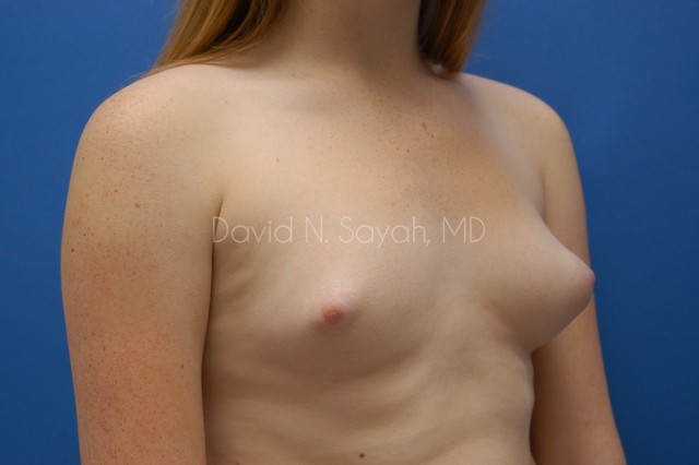Breast Reconstruction Before and After | Sayah Institute