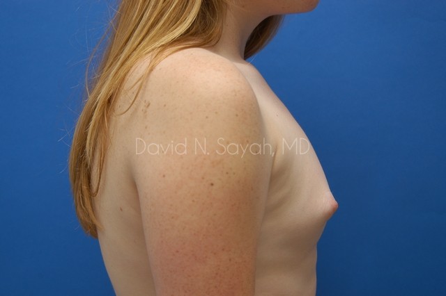 Breast Reconstruction Before and After | Sayah Institute