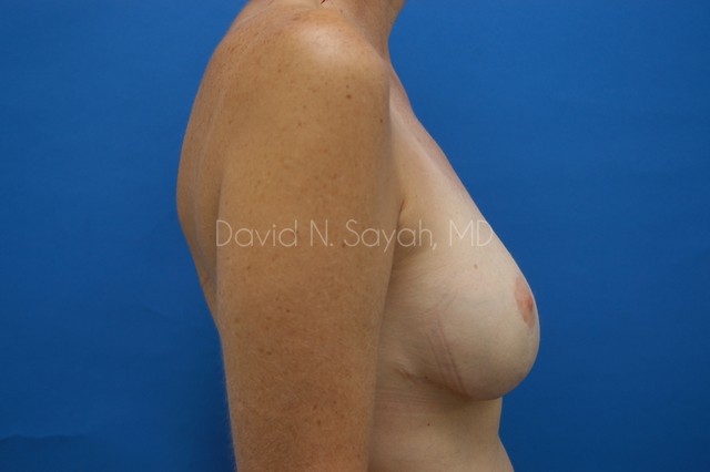 Breast Reconstruction Before and After | Sayah Institute