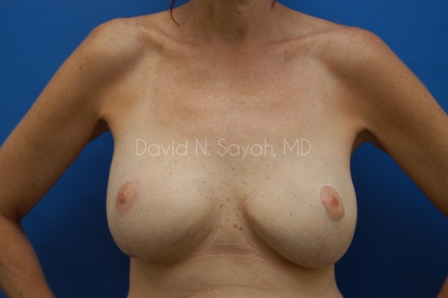 Breast Reconstruction Before and After | Sayah Institute