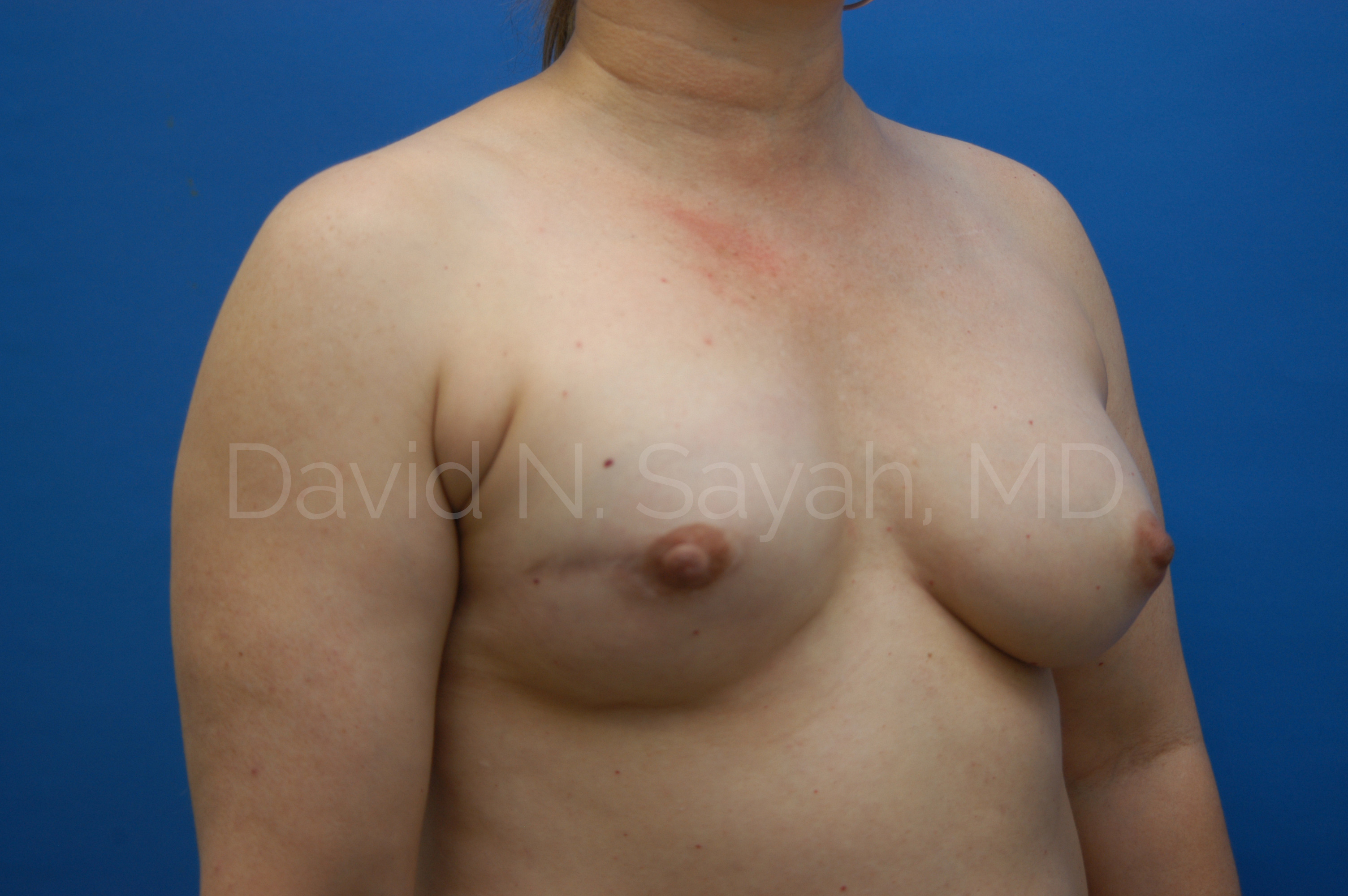 Breast Reconstruction Before and After | Sayah Institute