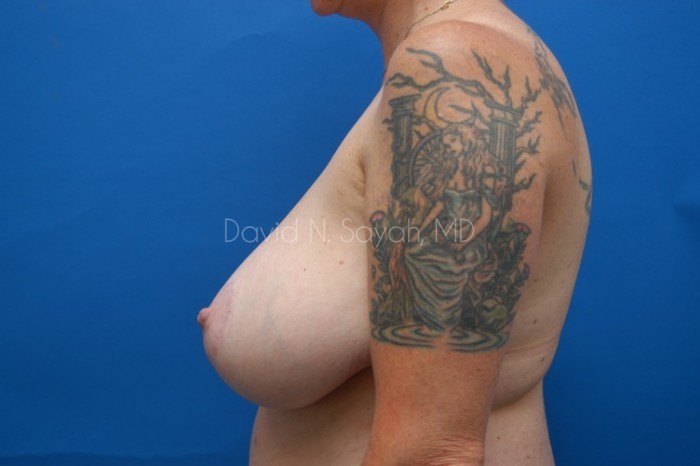 Breast Reduction Before and After | Sayah Institute