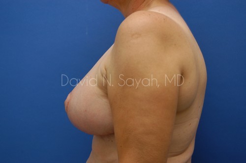 Breast Reduction Before and After | Sayah Institute