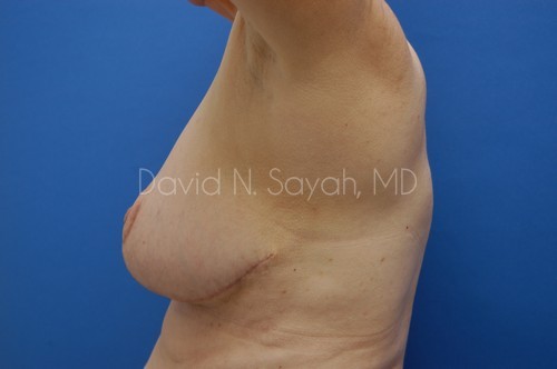 Breast Reduction Before and After | Sayah Institute