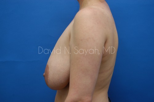 Breast Reduction Before and After | Sayah Institute