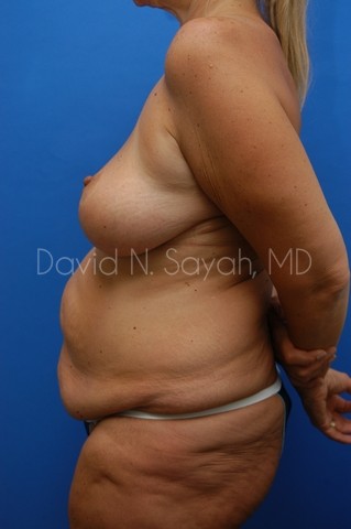 Breast Reduction Before and After | Sayah Institute