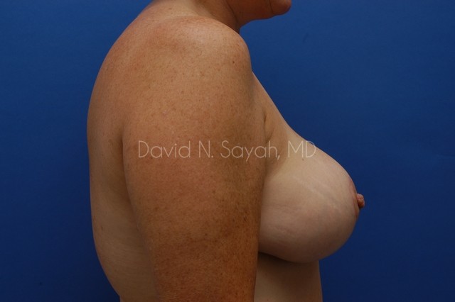 Breast Reduction Before and After | Sayah Institute