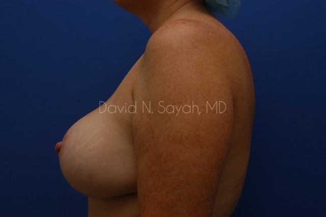 Breast Reduction Before and After | Sayah Institute