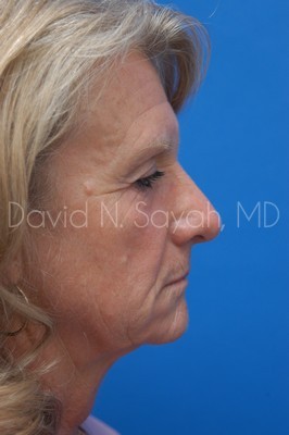 Brow Lift Before and After | Sayah Institute