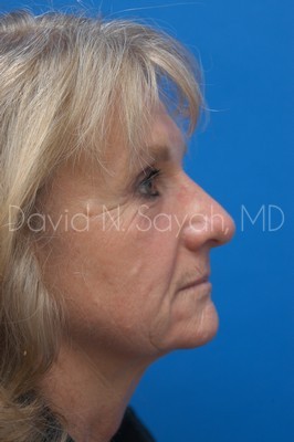 Brow Lift Before and After | Sayah Institute