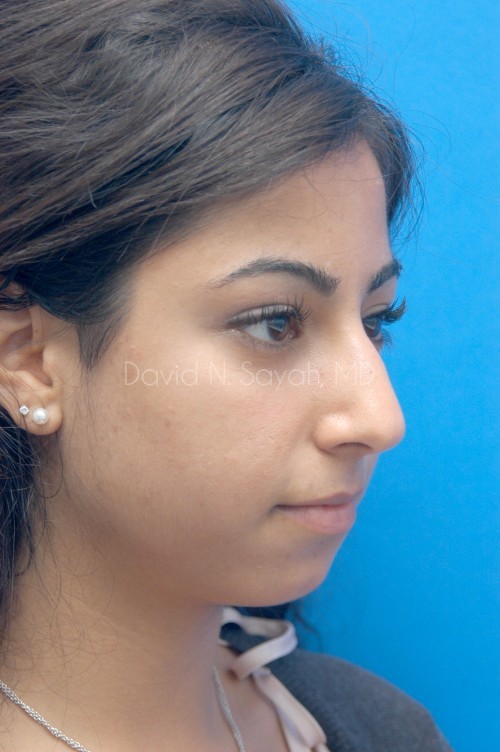 Chin Implant Before and After | Sayah Institute