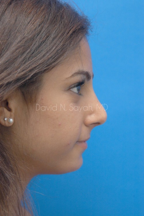 Chin Implant Before and After | Sayah Institute