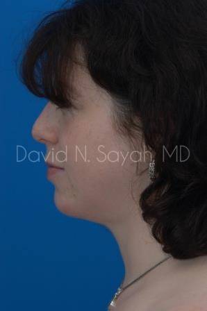 Chin Implant Before and After | Sayah Institute