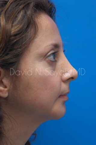 Chin Implant Before and After | Sayah Institute