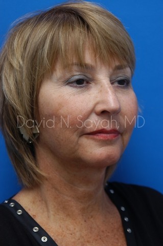 Chin Implant Before and After | Sayah Institute
