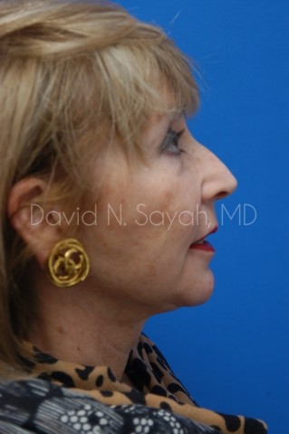 Chin Implant Before and After | Sayah Institute