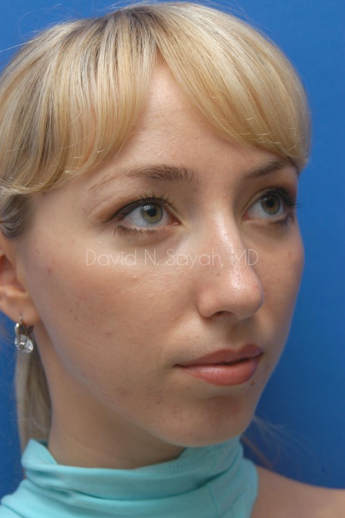 Chin Implant Before and After | Sayah Institute
