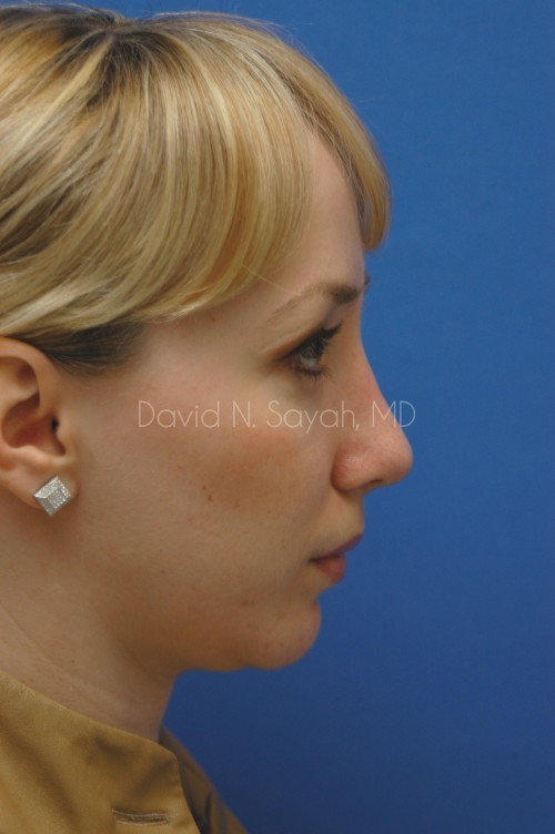 Chin Implant Before and After | Sayah Institute