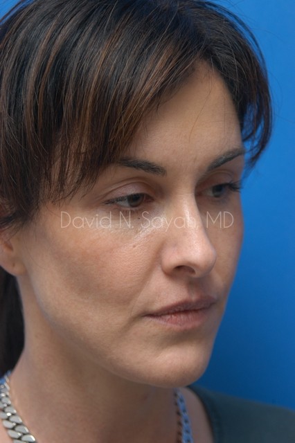 Chin Implant Before and After | Sayah Institute