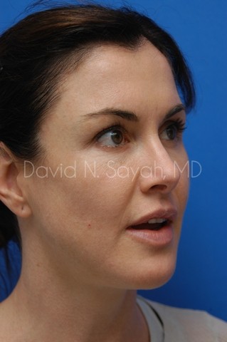 Chin Implant Before and After | Sayah Institute