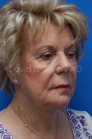 Chin Implant Before and After | Sayah Institute