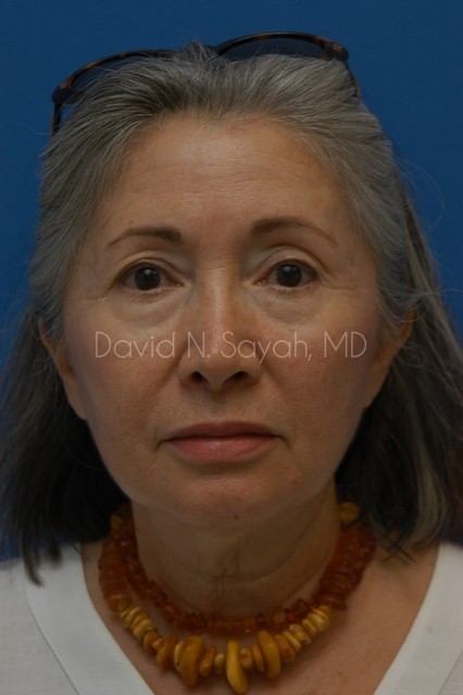 Chin Implant Before and After | Sayah Institute