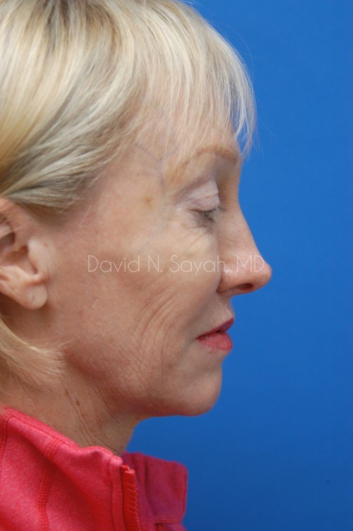 Co2 Laser Before and After | Sayah Institute