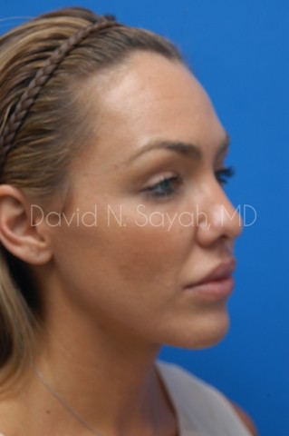 Co2 Laser Before and After | Sayah Institute