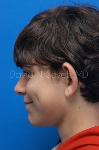 Ear Surgery Before and After | Sayah Institute